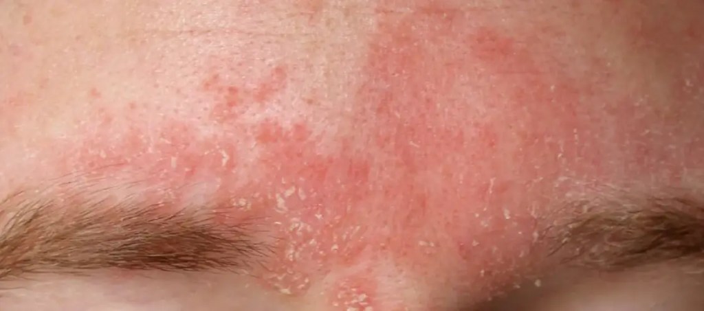 อาการของโรคภูมิแพ้เซ็บเดิร์ม